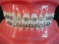 Metal Braces